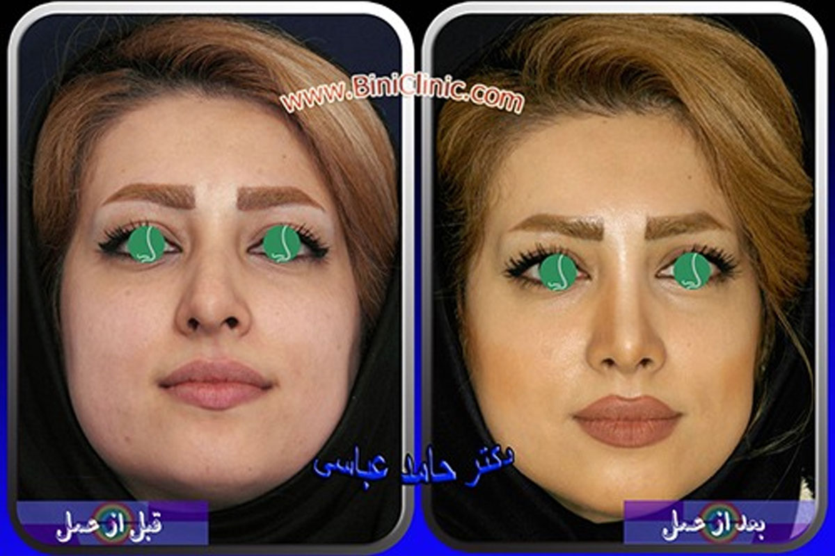 قبل و بعد عمل جراحی بینی